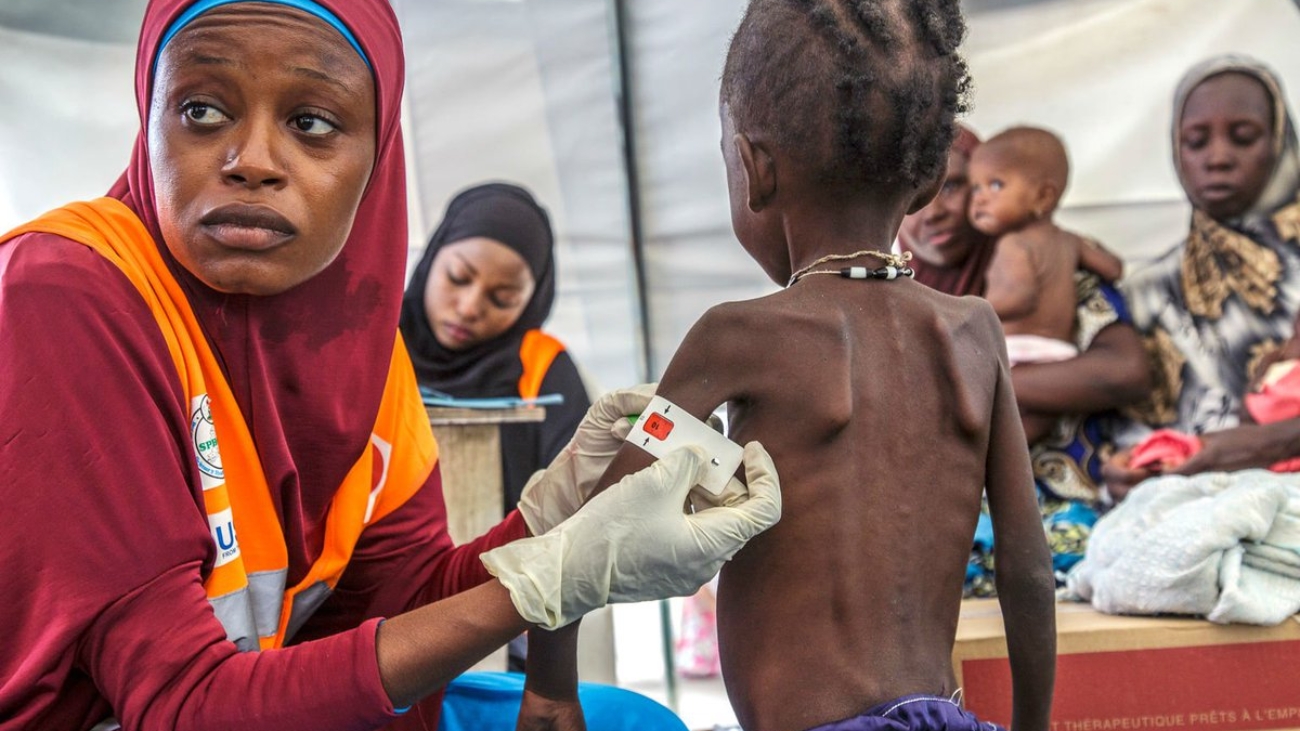 Severe-Acute-Malnutrition-of-nigeria